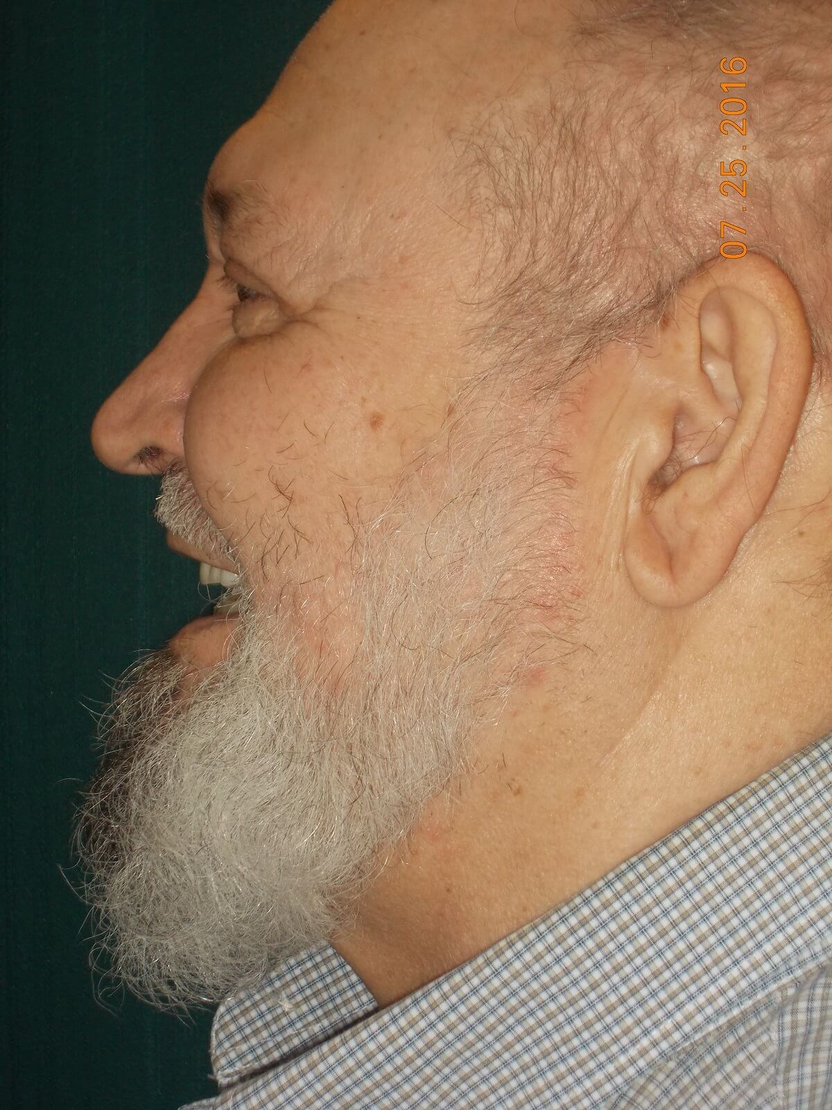 Side View After