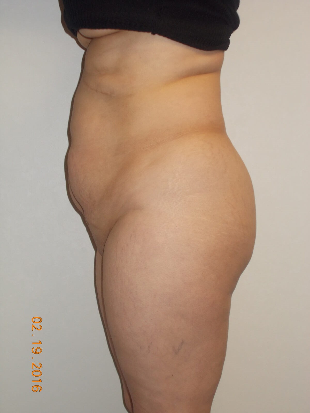 Side View Before