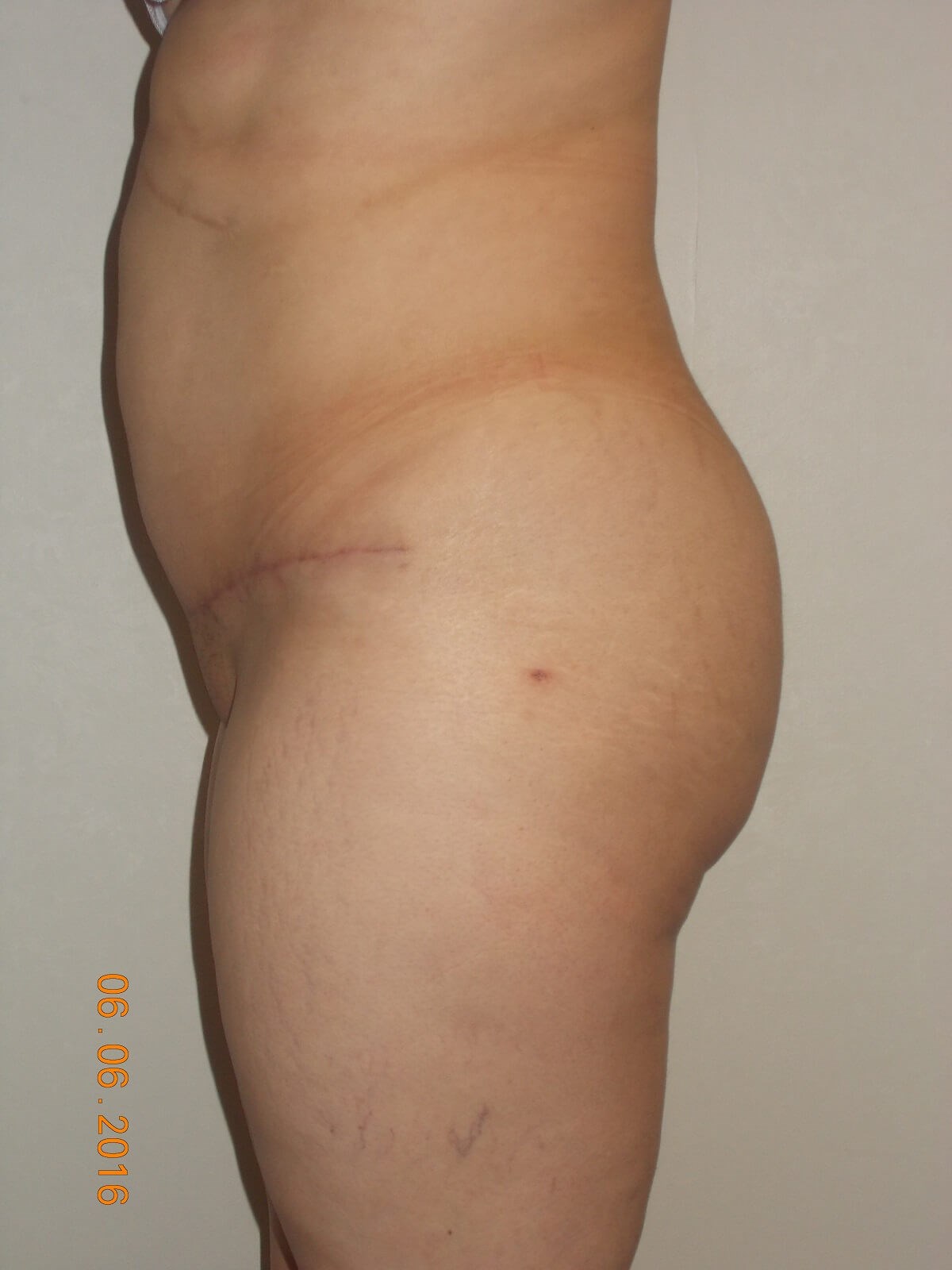 Side View After