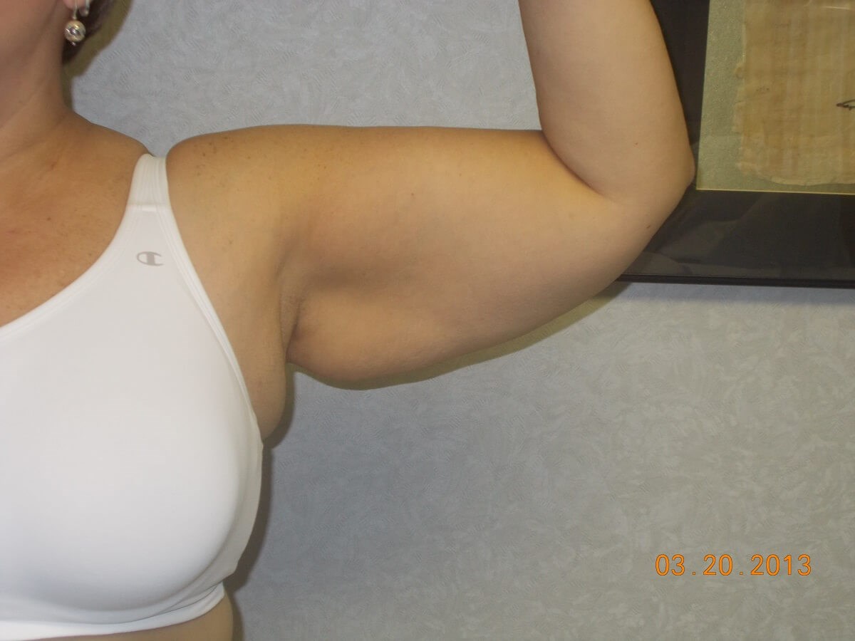 Front View Of Left Arm Before