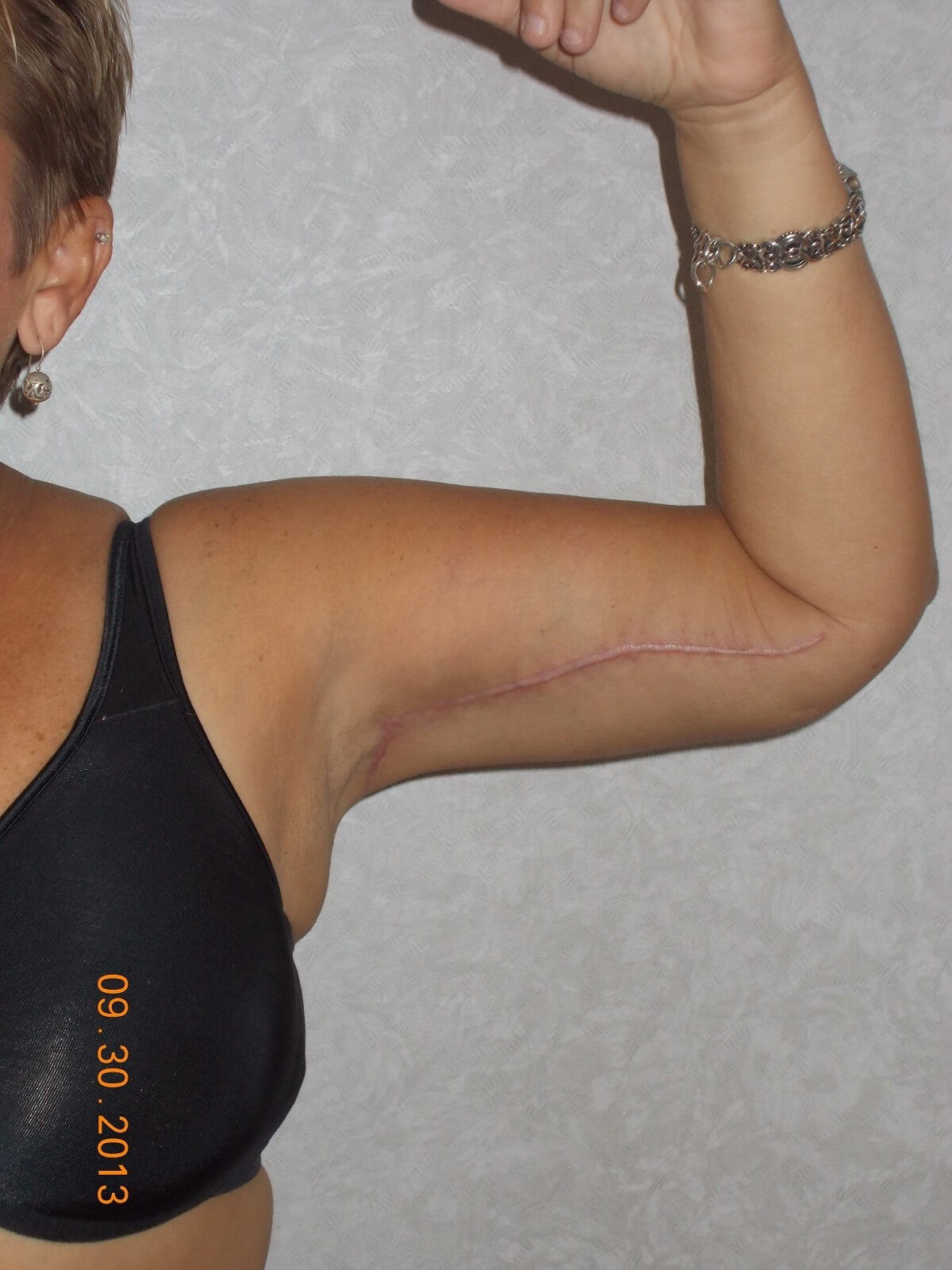 Front View Of Left Arm After